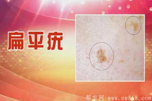 痤瘡|酒糟鼻|扁平疣|尋常疣|傳染性軟疣|尖銳濕疣 痤瘡|酒糟鼻|扁平疣|尋常疣|傳染性軟疣|尖銳濕疣