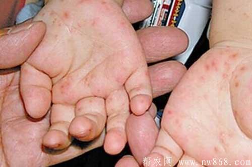 如何根據手足口病癥狀初期圖片判斷病情